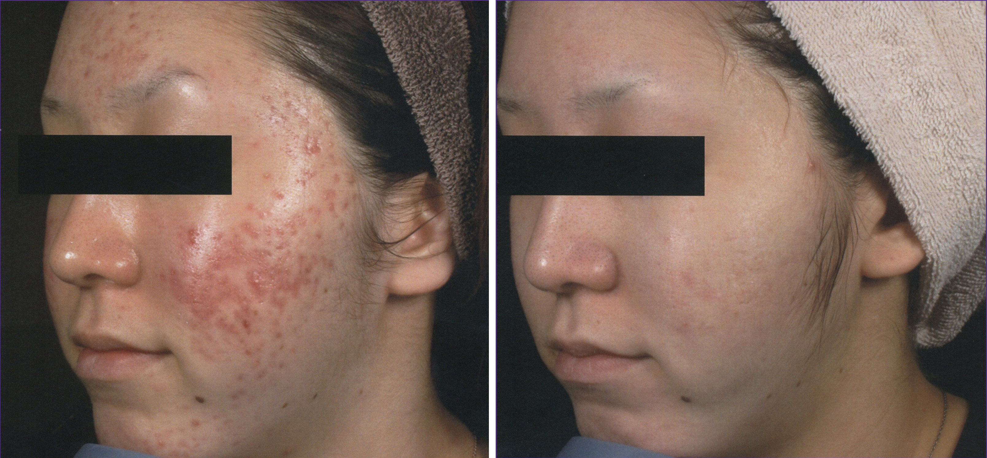 Intensif Microneedling for Acne Scars by EndyMed