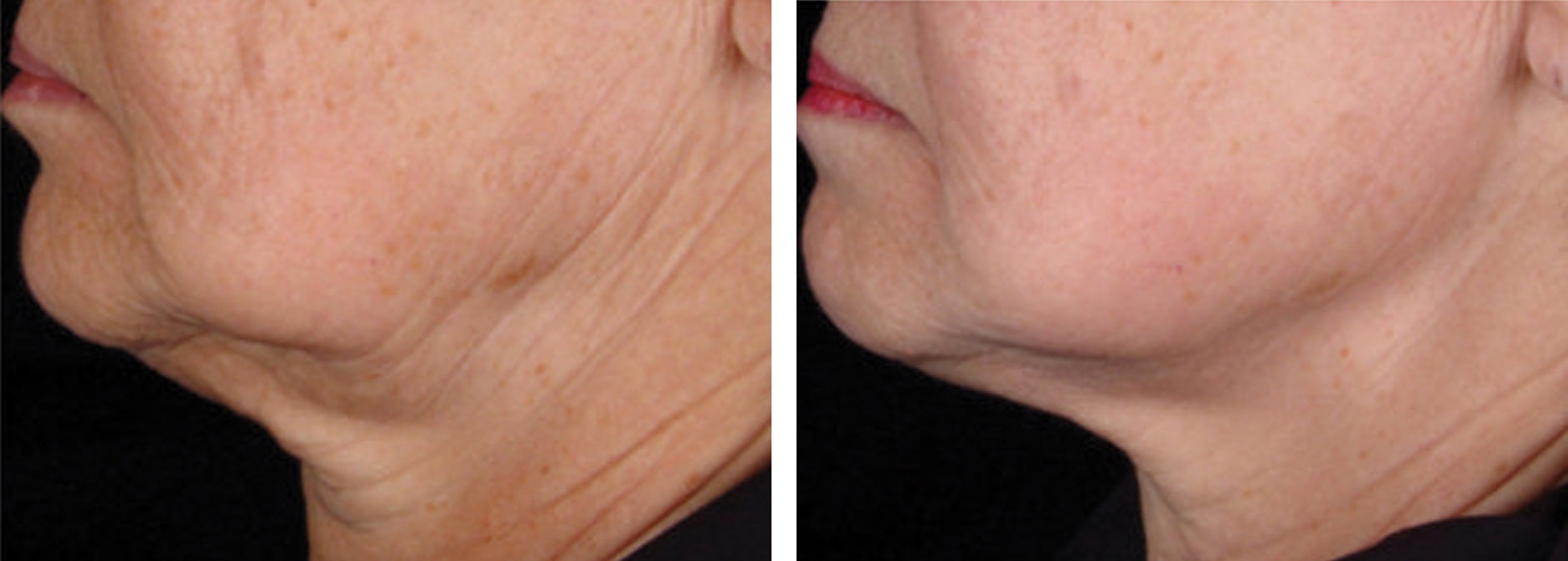 Intensif Microneedling with Radio Frequency Before and After 2